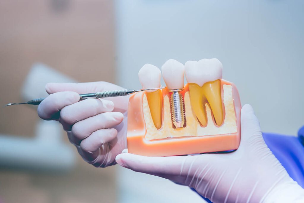 Cost of Dental Implants with Insurance in 2025