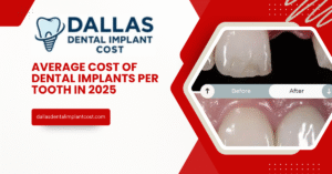 Average Cost of Dental Implants Per Tooth in 2025