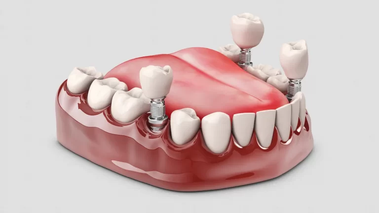 cost of dental implants on Long Island