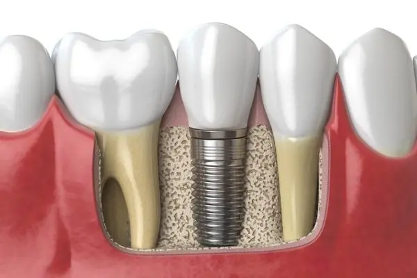 Cost of dental implants in the USA
