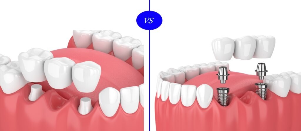 Dental Bridge vs. Implant Cost in 2025