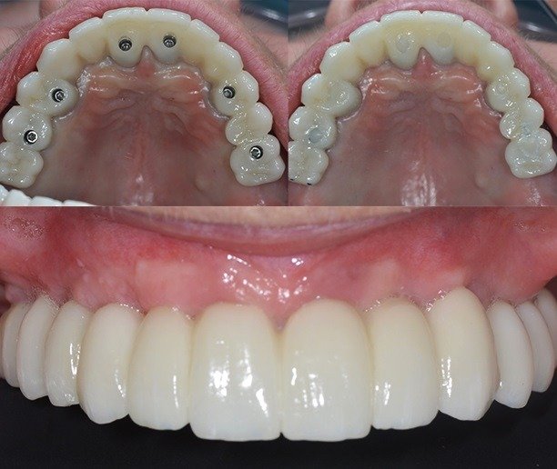 True Cost of All-on-6 Dental Implants in 2025