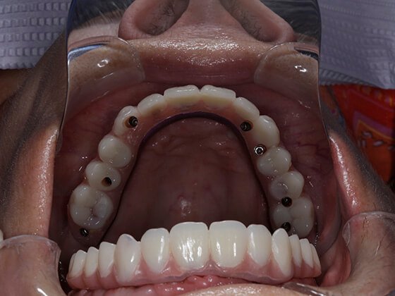 Cancun Dental Implants Cost 2025