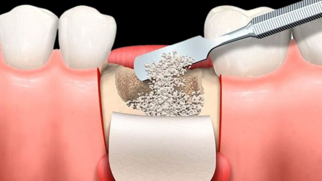 Colombia Dental Implants Cost