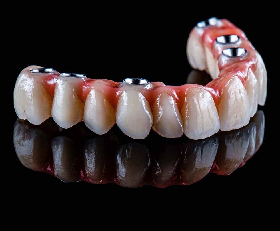 Dental Implant Costs in Los Angeles