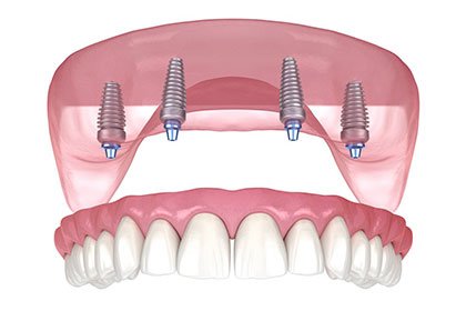 All-on-4 Dental Implants in Costa Rica