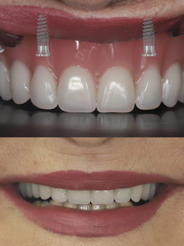 03-be-implant-pour-machoire-complete