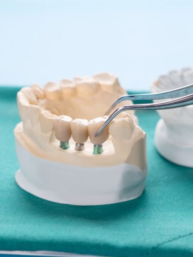 Cost of Implant-Supported Dentures at Aspen Dental