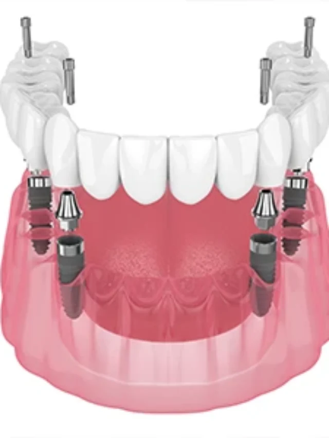 https://dallasdentalimplantcost.com/finding-truly-affordable-dental-implant-costs/
