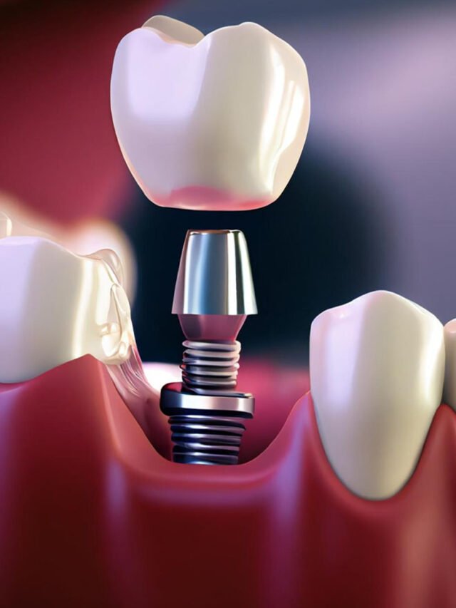 Dental-Implant (1)