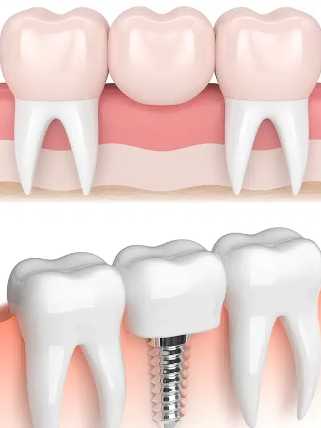 Dental_Bridge_vs._Implant_–_What_You_Should_Know_Before_Deciding (1)