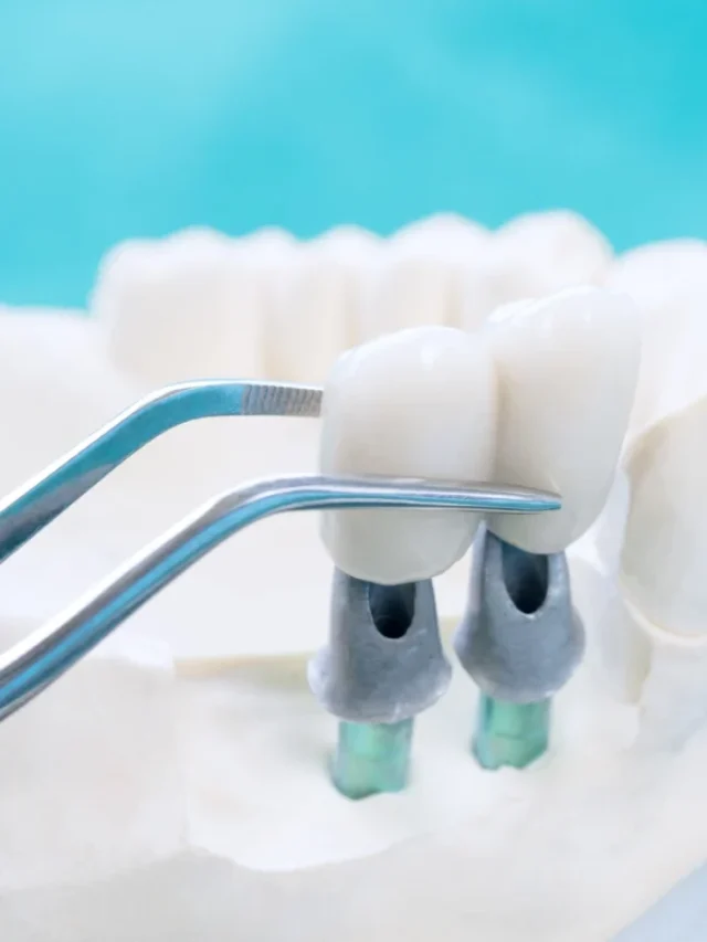 Discover-the-Types-of-Dental-Implants-Available-in-Turkey-01_1748203506-1162x775