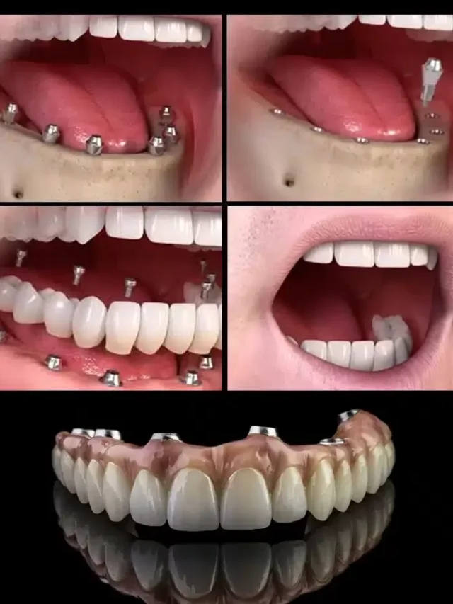Full-Mouth-Dental-Implants-jpg