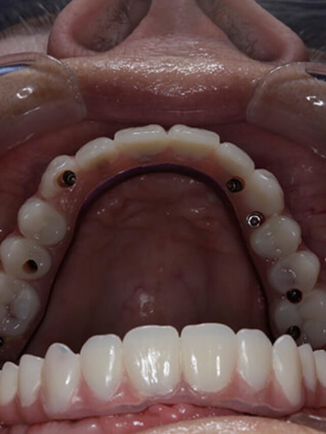 https://dallasdentalimplantcost.com/cost-of-dental-implants-in-india/