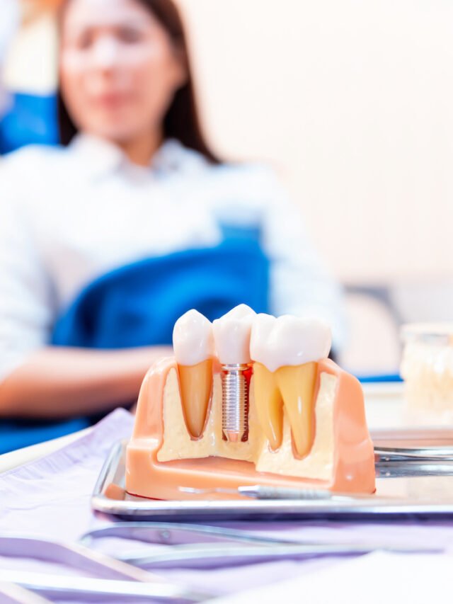 Dental Implant Cost Los Angeles for 2025