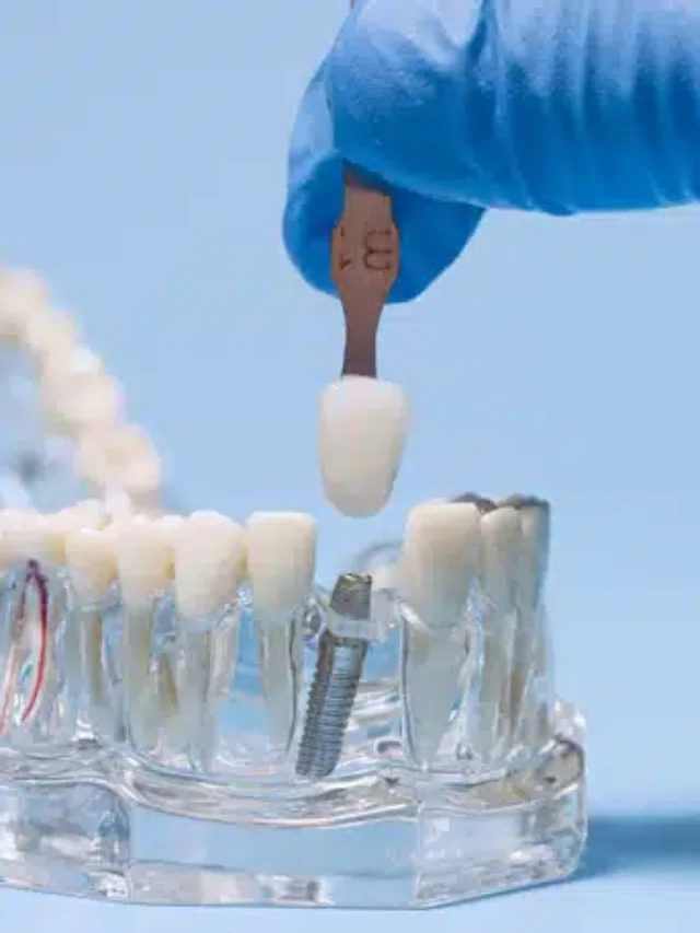 Tooth-implant-shade-matching-with-dental-guide-