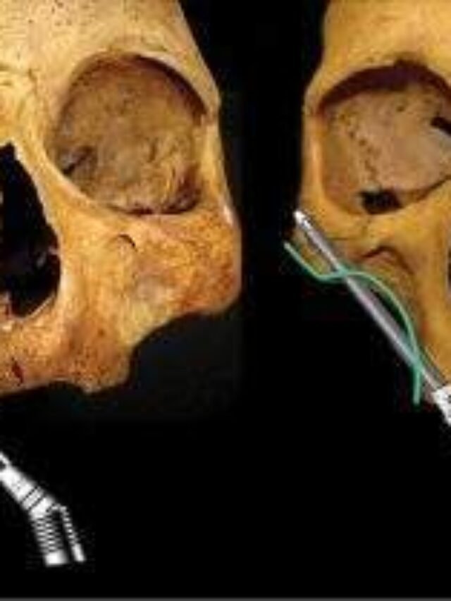 Zygomatic Implant Costs, 2025, Price Guide