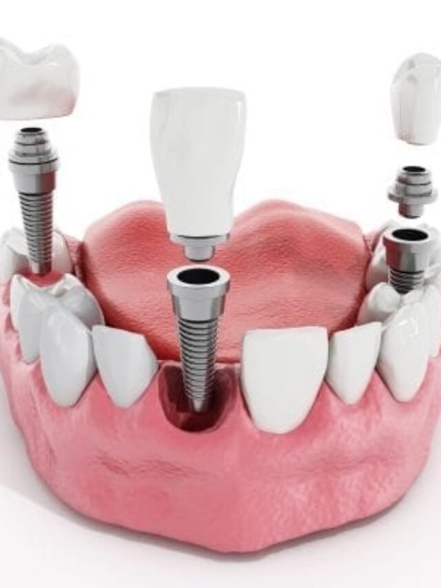 Dental Implant & Crown Cost: Your 2025 Breakdown