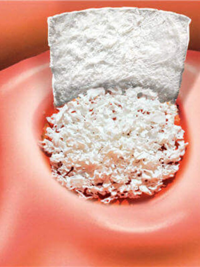 bone-grafting-for-dental-implants