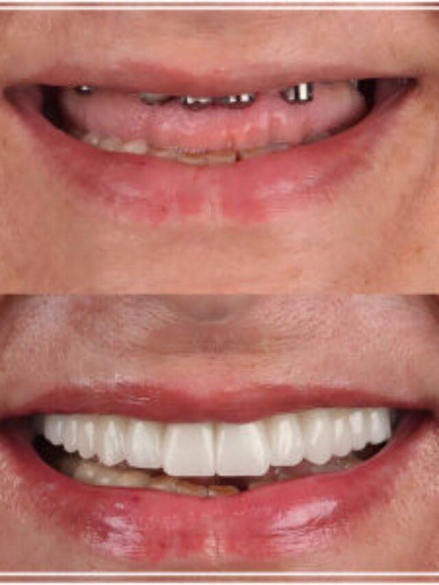 Upper Dental Implant Cost 2025