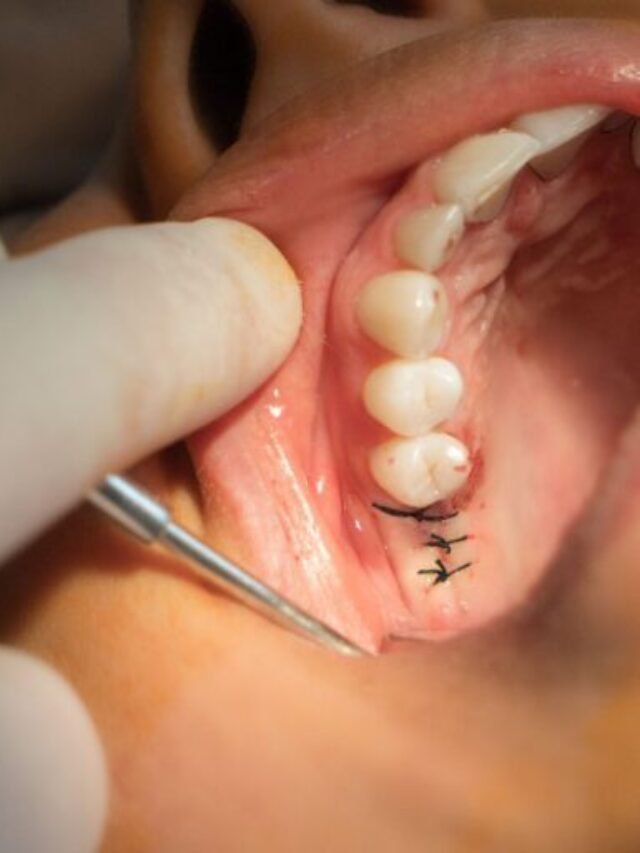 Dental Implant Costs Near Me: Your 2025 Price Guide