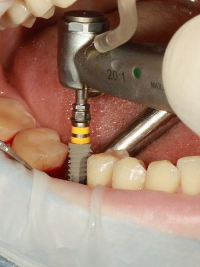 dental-implant-surgery-pil7dgpyke16xtecyd68tkjnfdgw5fpz7y3bciaqvc