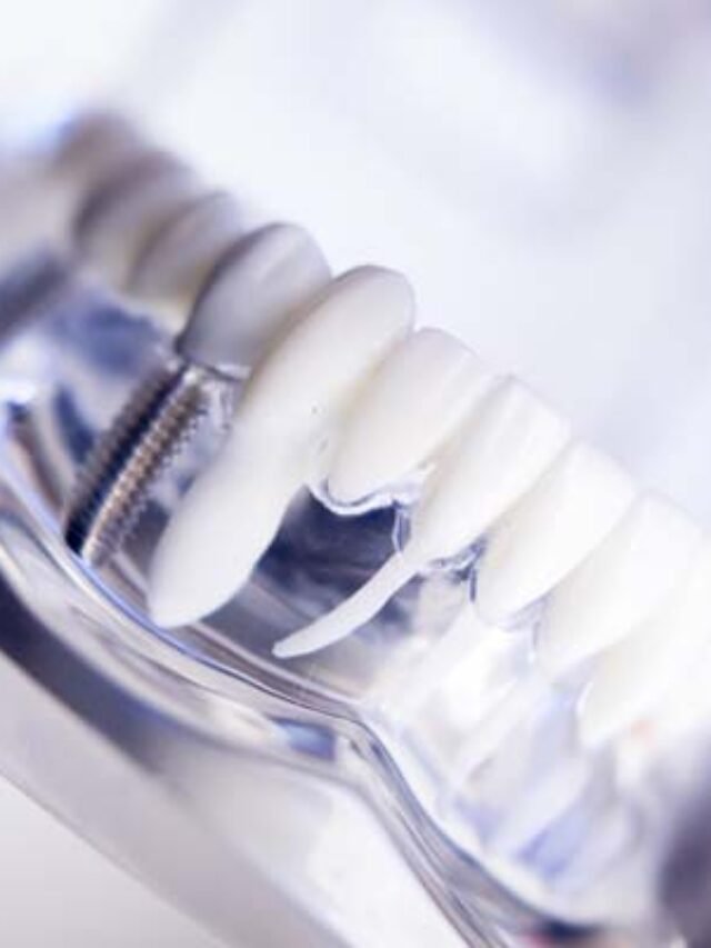 https://dallasdentalimplantcost.com/dental-implants-without-insurance/