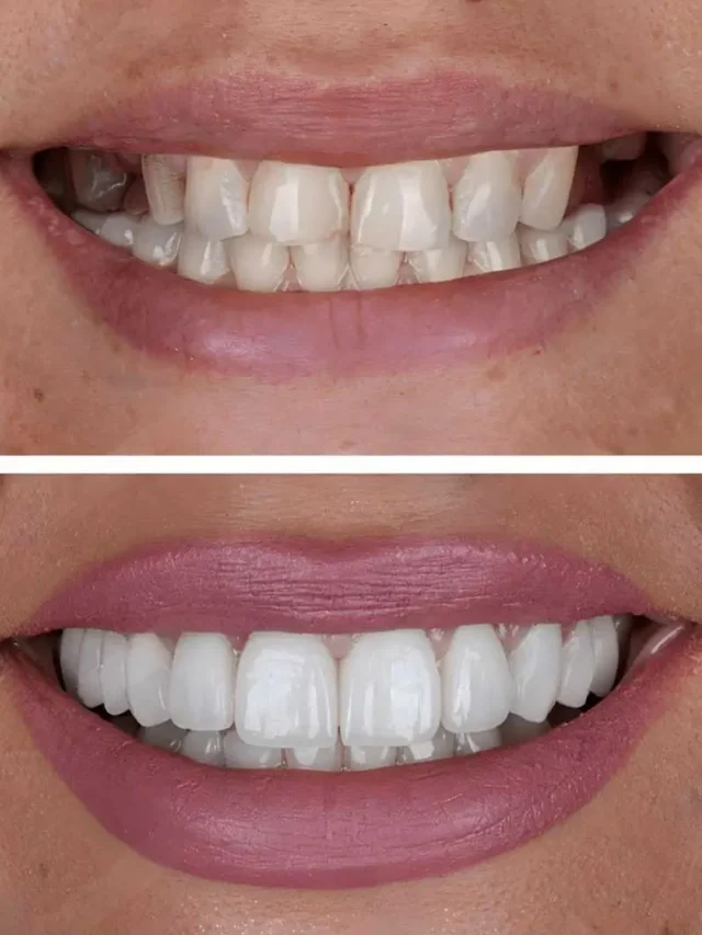 dental-implants-before-and-after