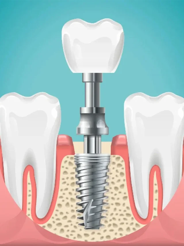 dental-implants