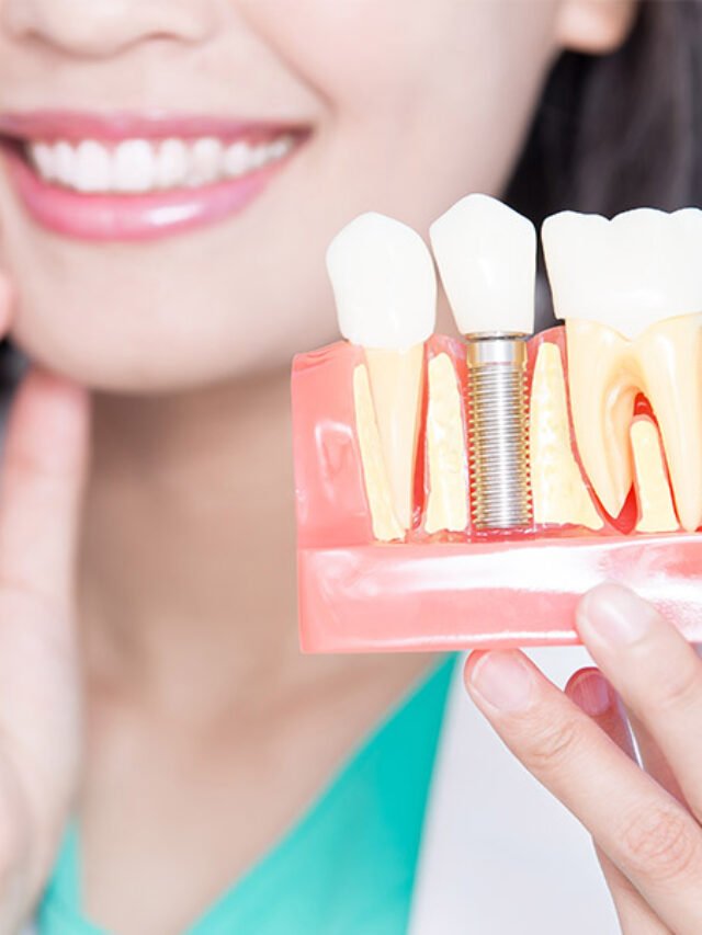 dental-implants-in-kelowna