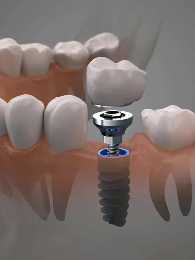 dentist-loop-chicago-affordable-dental-implants-find-the-best-dental-implant-deals-in-downtown-chicago-1