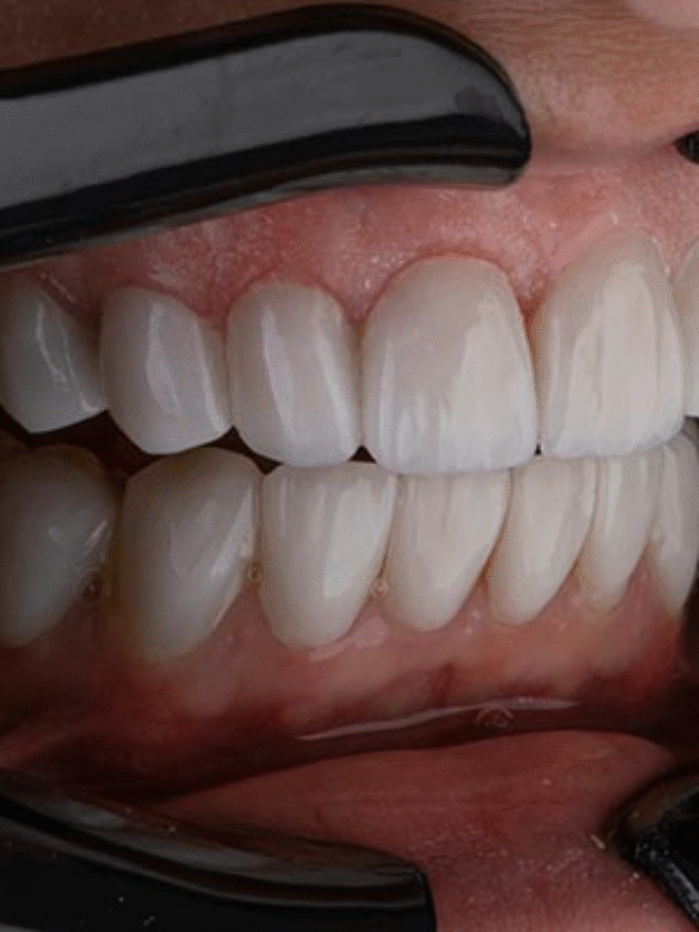 Dental Implant Cost in Turkey: Is It Worth the Trip?