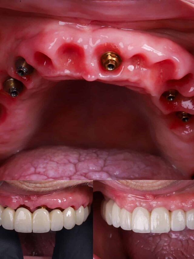 ejemplo-implantes-all-on-6