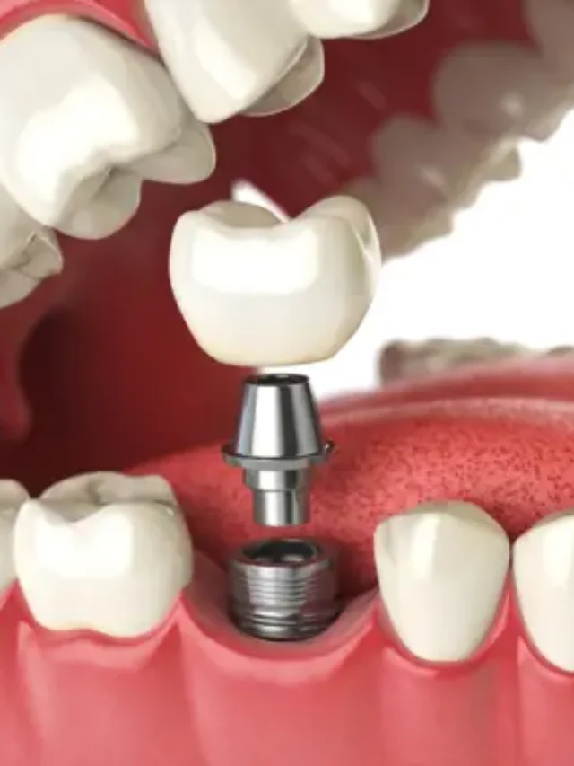 facts-about-dental-implants