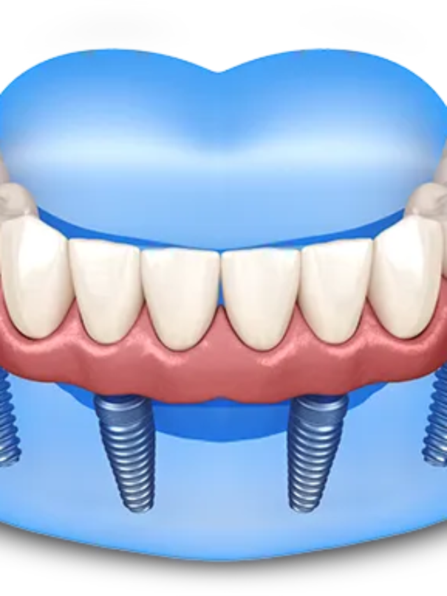 full-arch-implants.png