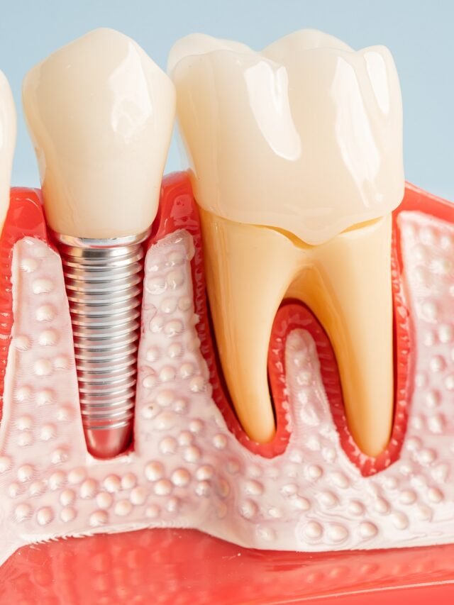 Dental implant, artificial tooth roots into jaw, root canal of d