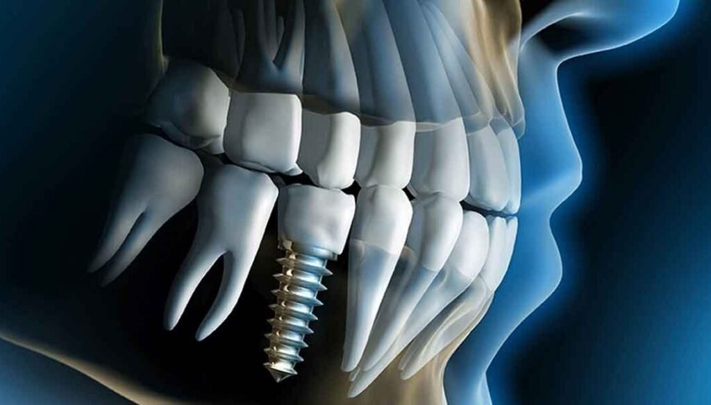 The Real Dental Implant Cost in Tijuana, Mexico