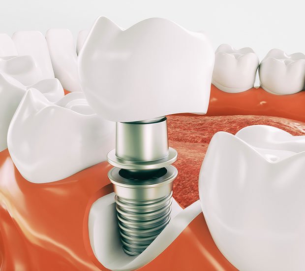 Dental Implants Without Insurance in 2025