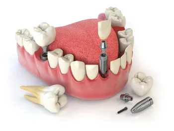 Cost of Zygomatic Dental Implants 