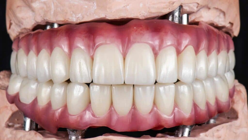 Dental Implants for Your Entire Mouth