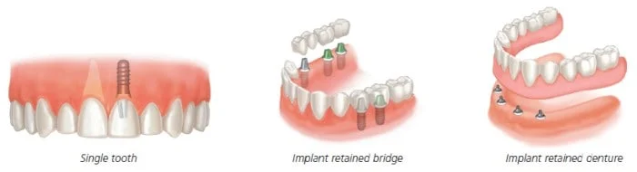 Average Cost of Complete Dental Implants 