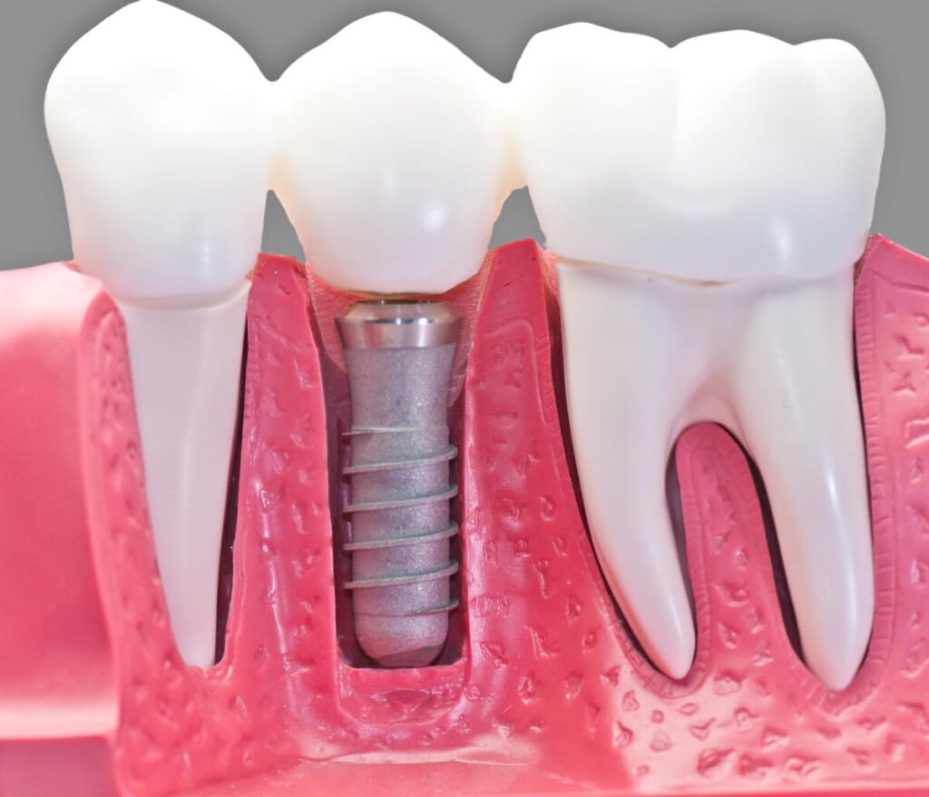 Cost of full mouth dental implants San Francisco CA