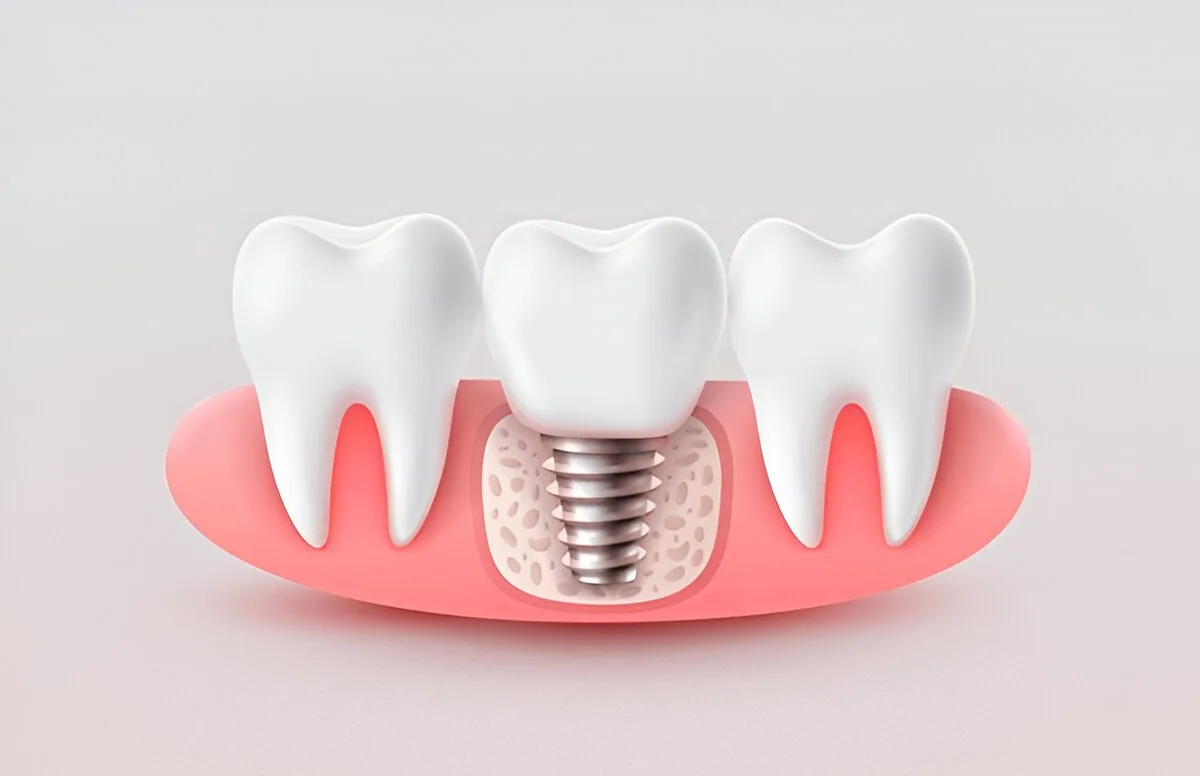 Unveiling the Cost of Aspen Dental Implants in 2025