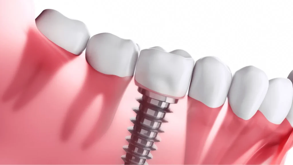 Average Price of a Dental Implant Per Tooth in 2025?