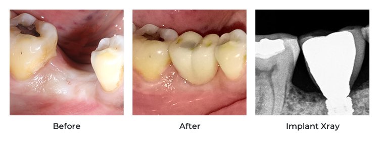 Cost of Dental Implants in India