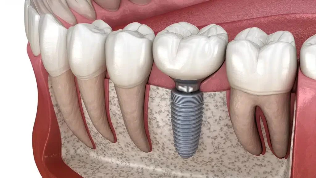 Costa Rica Dental Implants Problems