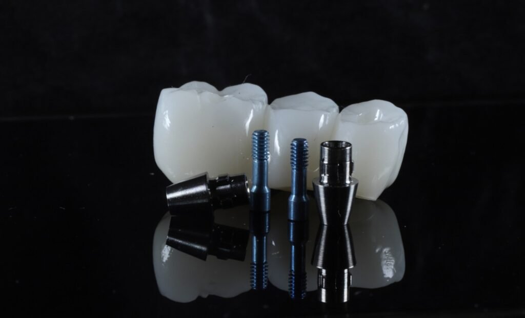 Cost of Upper Dental Implants in 2025