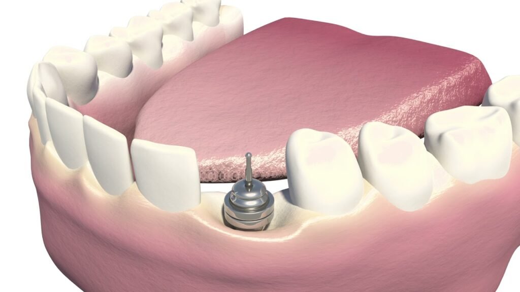 Cost of Implant-Supported Dentures at Aspen Dental