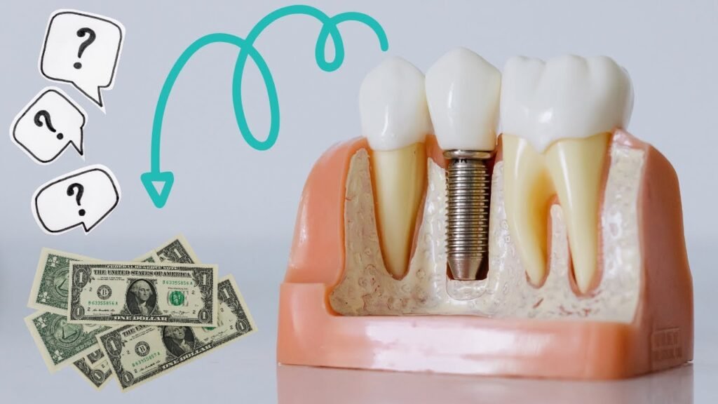 Dental Implants Costs in the USA
