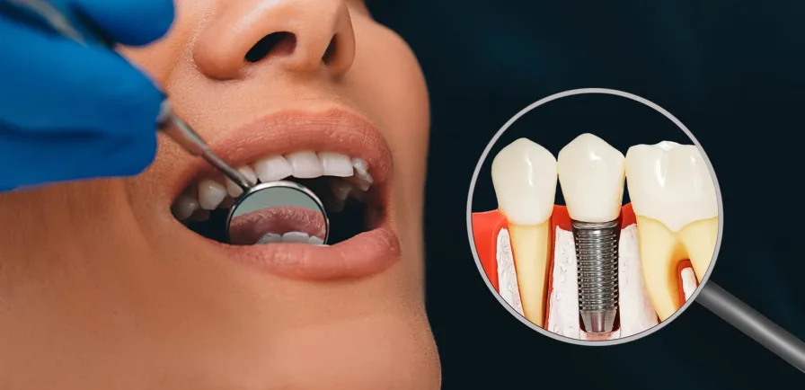 Dental Implant Cost in Turkey 
